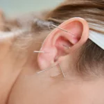 beautiful-woman-relaxing-bed-having-acupuncture-treatment-with-needles-around-her-ear