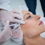 woman-with-marked-face-receiving-botox-injection